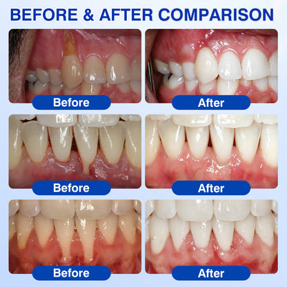 🇺🇸🎁Evolvion® GumRevive Periodontal Repair Gel