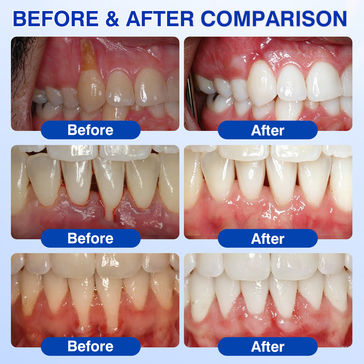 🇺🇸🥇🦷✅Evolvion® GumRevive Periodontal Repair Gel