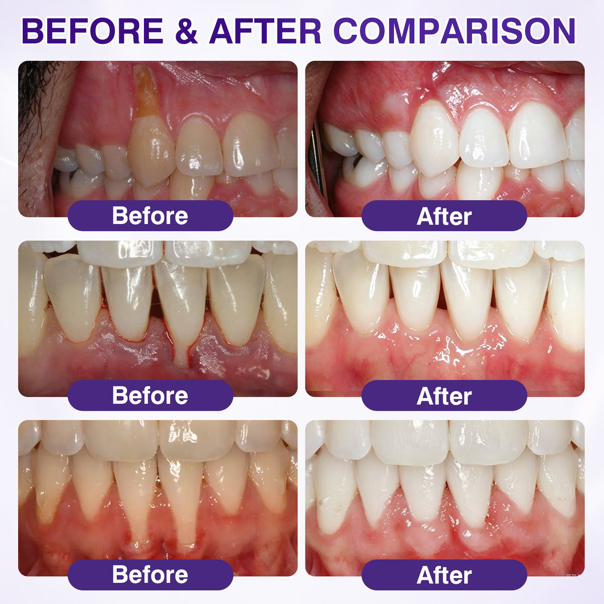 🇺🇸👨‍⚕️✅️Advanced Formula🦷Evolvion® GumRevive Periodontal Repair Gel